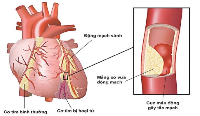 Xơ vữa động mạch là gì